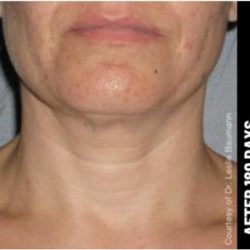 Ultherapy Before & After Patient #1554